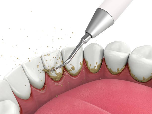 Ultrasonic Teeth Cleaning